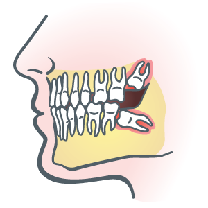 Impacted Wisdom Teeth